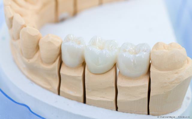 Zahnkronen, Brücken und Zahnprothesen