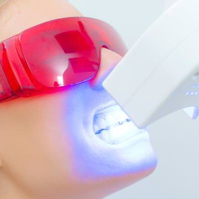 Power-Bleaching: Weiße Zähne in einem Termin